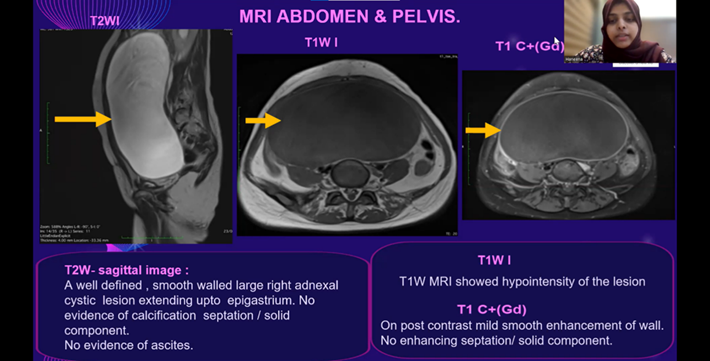 Ovarian Cyst